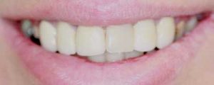 Moorestown Dentist Smile Galllery