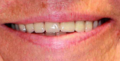 linda w 2 after dentures