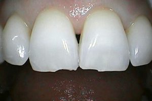 before dental bonding