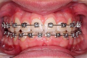 gonzalez l after orthodontics