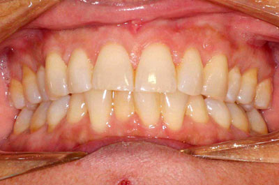 Paola S Before Orthodontics